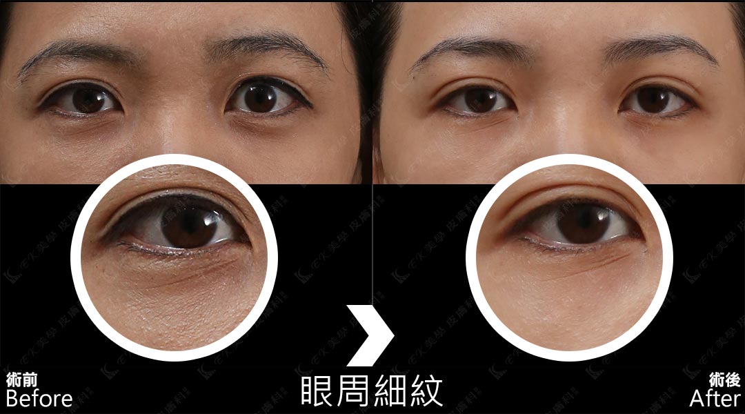 Tixel提可塑術前術後治療眼周細紋-02