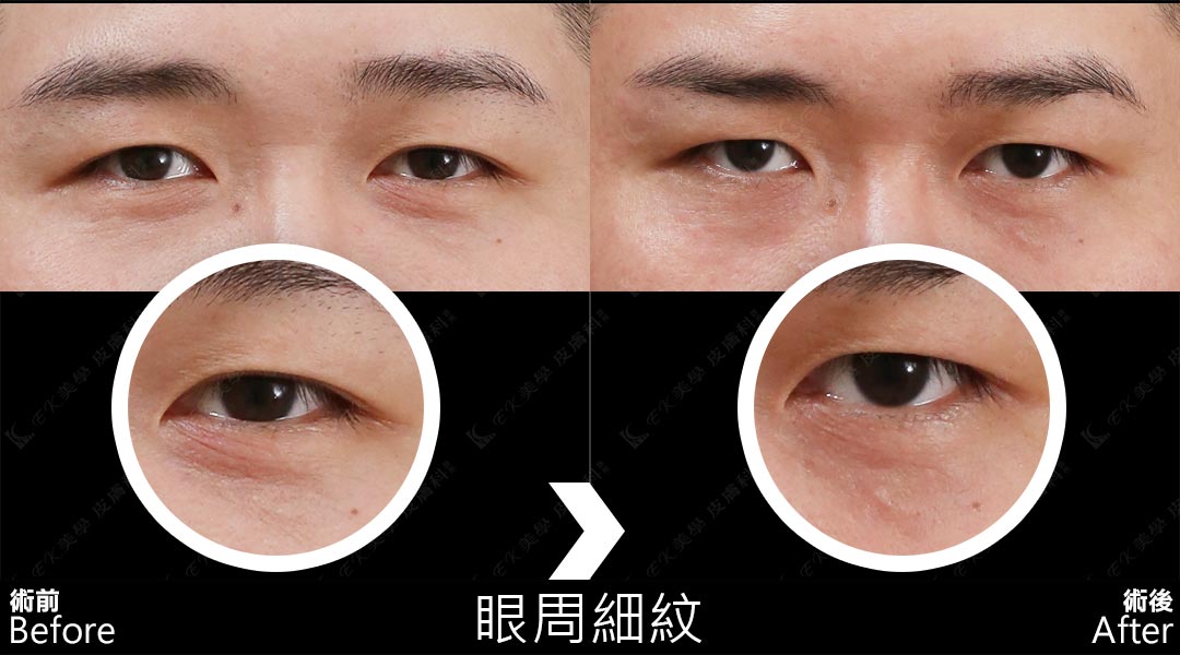 Tixel提可塑術前術後治療眼周細紋-05