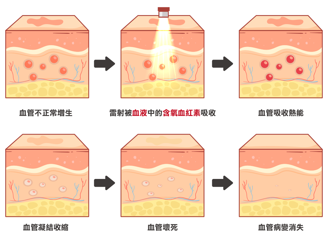 V雷射／血管雷射治療方法