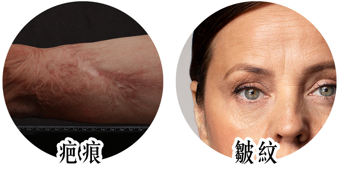 CO2二氧化碳雷射治療改善症狀：疤痕皺紋