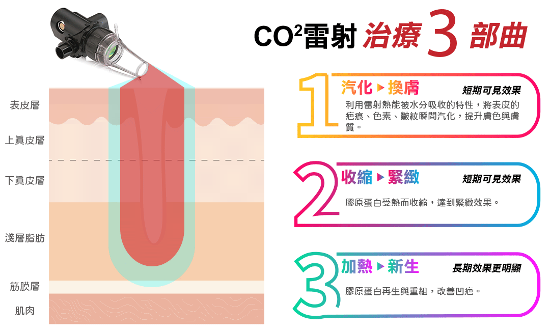CO2二氧化碳雷射治療原理